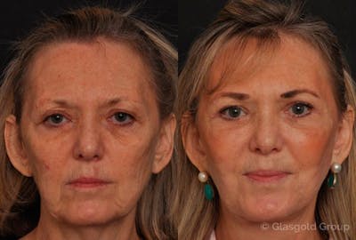 Upper Eyelid Before & After Gallery - Patient 363894 - Image 1