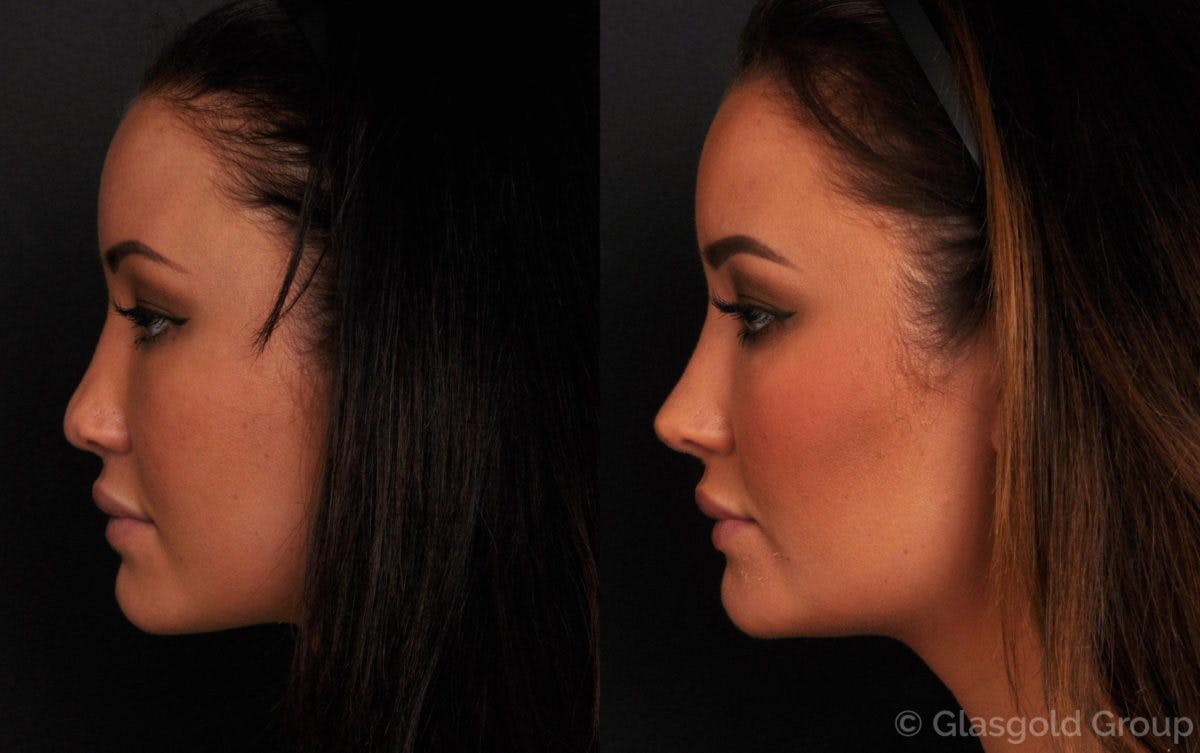 Revision Rhinoplasty Before & After Gallery - Patient 466199 - Image 1