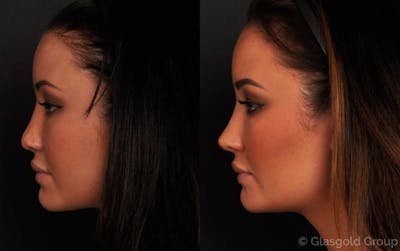 Revision Rhinoplasty Before & After Gallery - Patient 466199 - Image 1