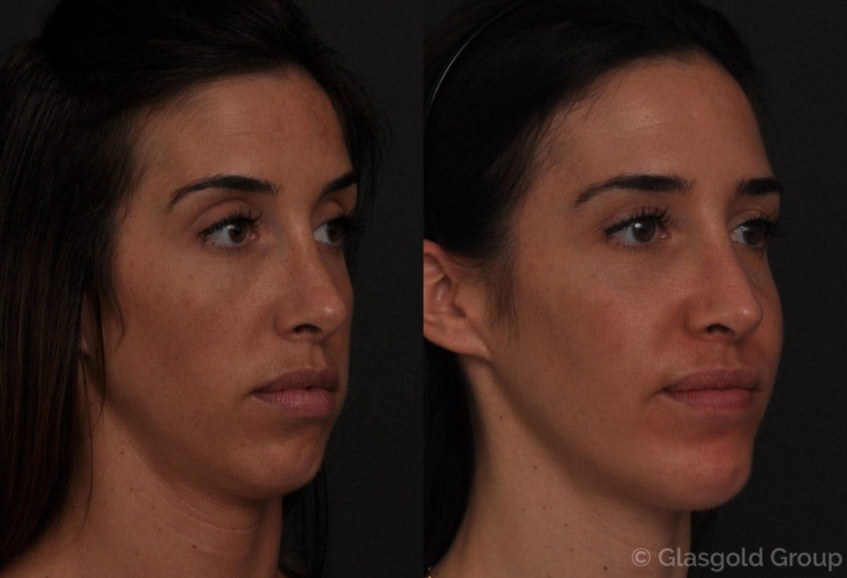 Chin Implants Before & After Gallery - Patient 573792 - Image 2