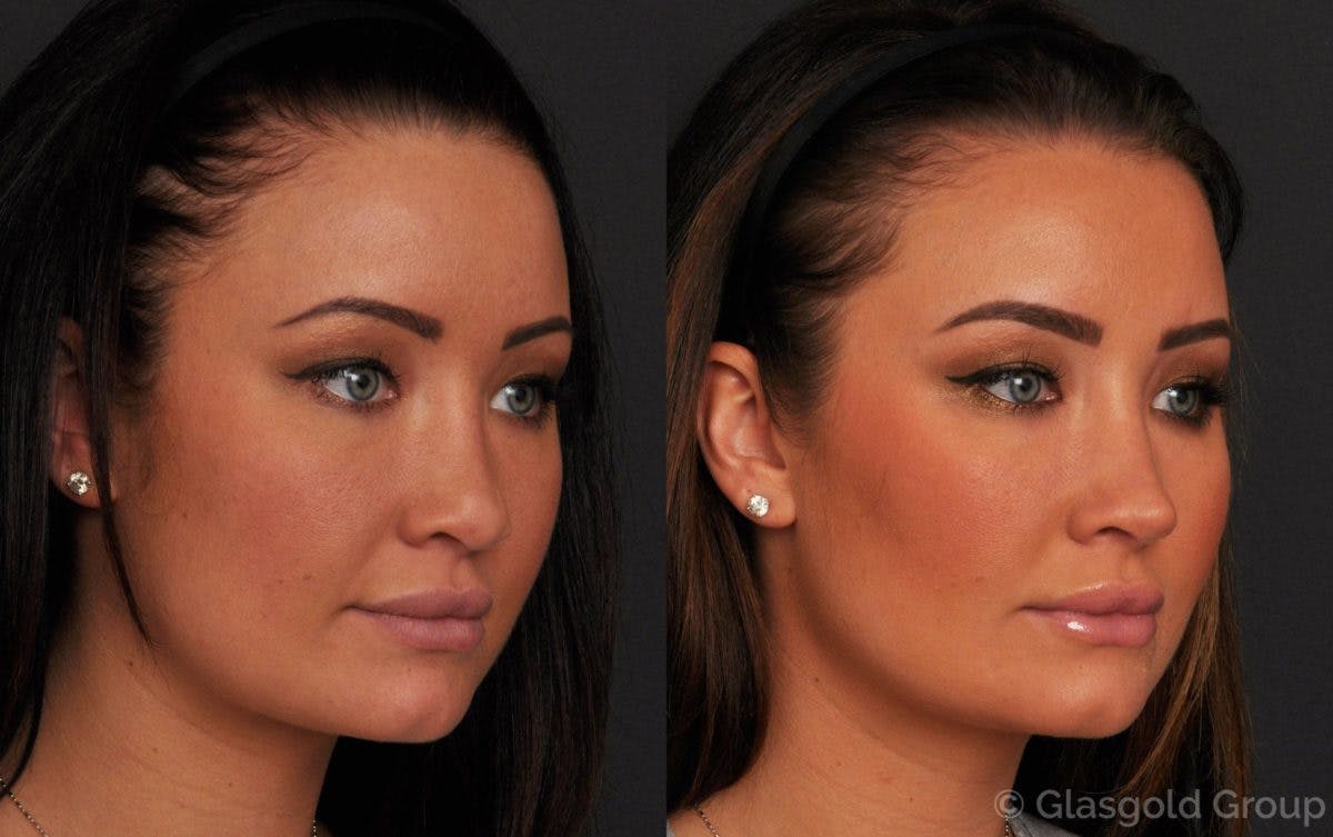 Revision Rhinoplasty Before & After Gallery - Patient 466199 - Image 3
