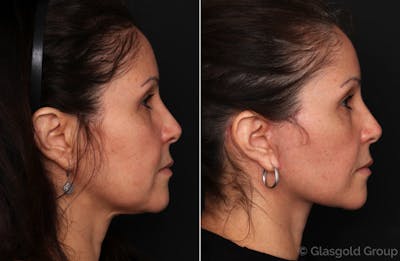 Facelift Before & After Gallery - Patient 100111 - Image 1