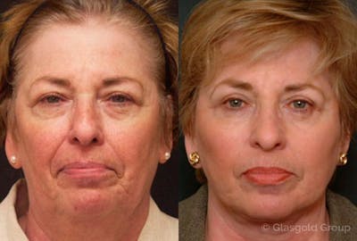 Upper Eyelid Before & After Gallery - Patient 980036 - Image 1