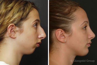 Chin Implants Before & After Gallery - Patient 861113 - Image 1