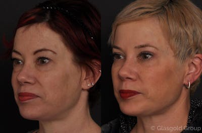 Lower Eyelid Before & After Gallery - Patient 344979 - Image 1