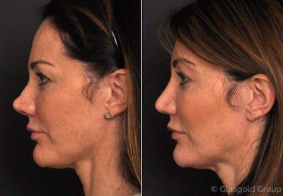 Revision Rhinoplasty Before & After Gallery - Patient 631577 - Image 1