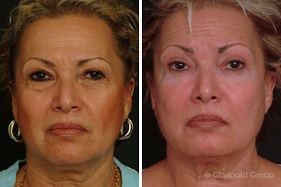 Upper Eyelid Before & After Gallery - Patient 200356 - Image 1