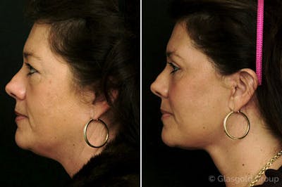 Facelift Before & After Gallery - Patient 341672 - Image 1