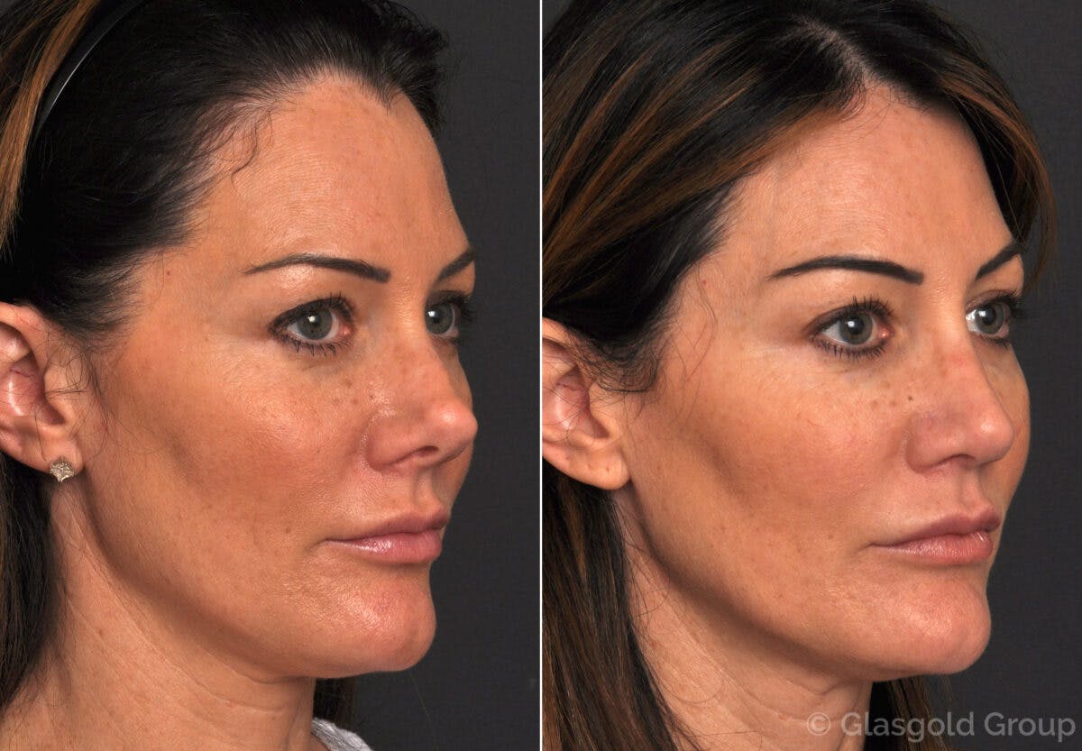 Revision Rhinoplasty Before & After Gallery - Patient 631577 - Image 3