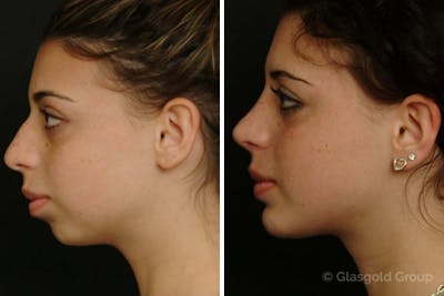 Chin Implants Before & After Gallery - Patient 189341 - Image 1