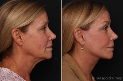 Facelift Before & After Gallery - Patient 644862 - Image 1