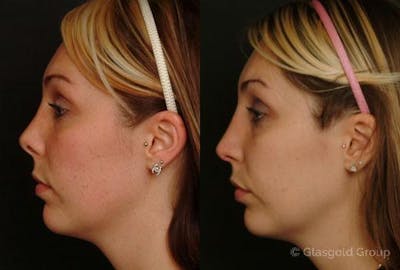 Revision Rhinoplasty Before & After Gallery - Patient 346847 - Image 1