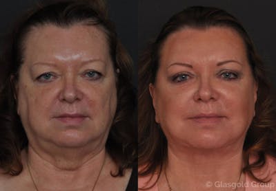 Upper Eyelid Before & After Gallery - Patient 306059 - Image 1