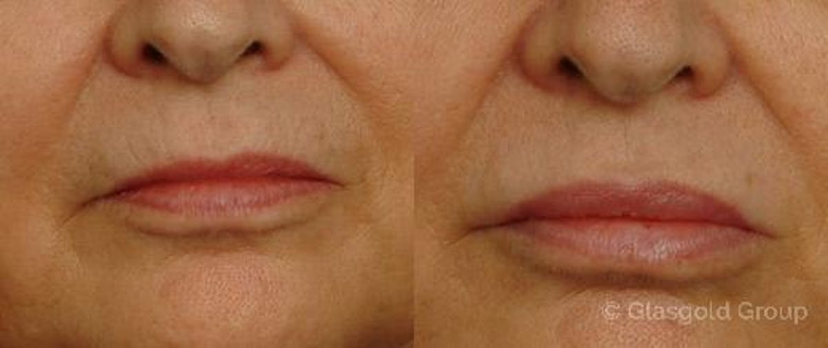 Lip Augmentation Before & After Gallery - Patient 188530 - Image 1