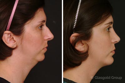 Chin Implants Before & After Gallery - Patient 160692 - Image 1