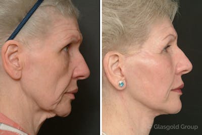 Facelift Before & After Gallery - Patient 333165 - Image 1