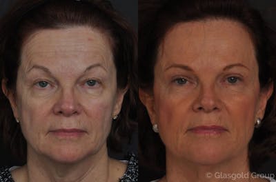 Upper Eyelid Before & After Gallery - Patient 254860 - Image 1