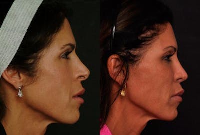 Revision Rhinoplasty Before & After Gallery - Patient 412833 - Image 1