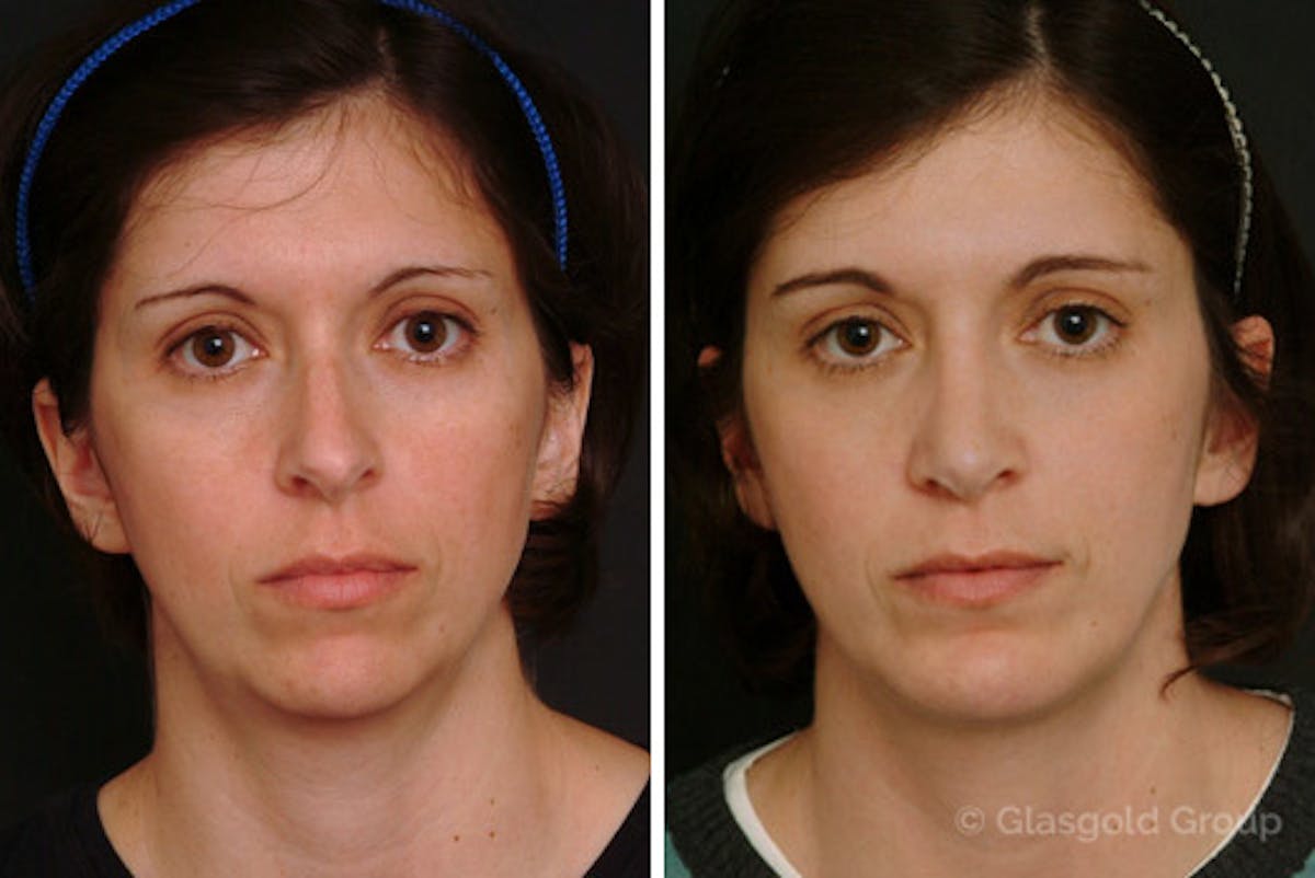 Chin Implants Before & After Gallery - Patient 160692 - Image 3