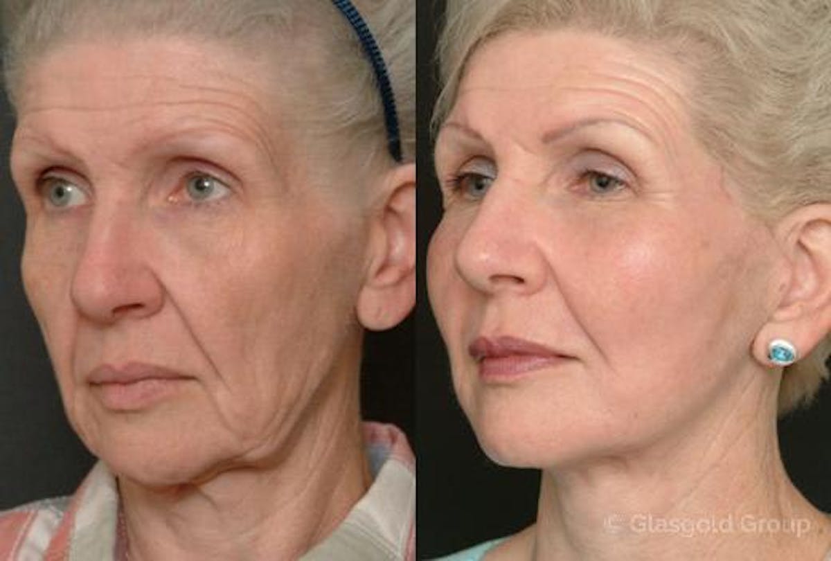 Facelift Before & After Gallery - Patient 333165 - Image 1