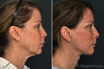 Facelift Before & After Gallery - Patient 115674 - Image 1