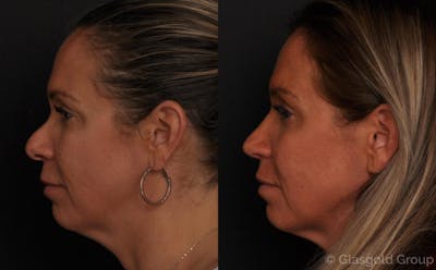 Revision Rhinoplasty Before & After Gallery - Patient 118932 - Image 1