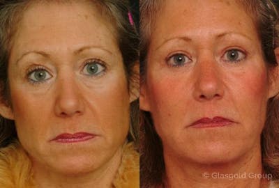 Upper Eyelid Before & After Gallery - Patient 158987 - Image 1