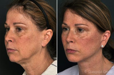 Facelift Before & After Gallery - Patient 115674 - Image 1