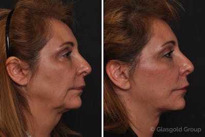 Facelift Before & After Gallery - Patient 210571 - Image 1