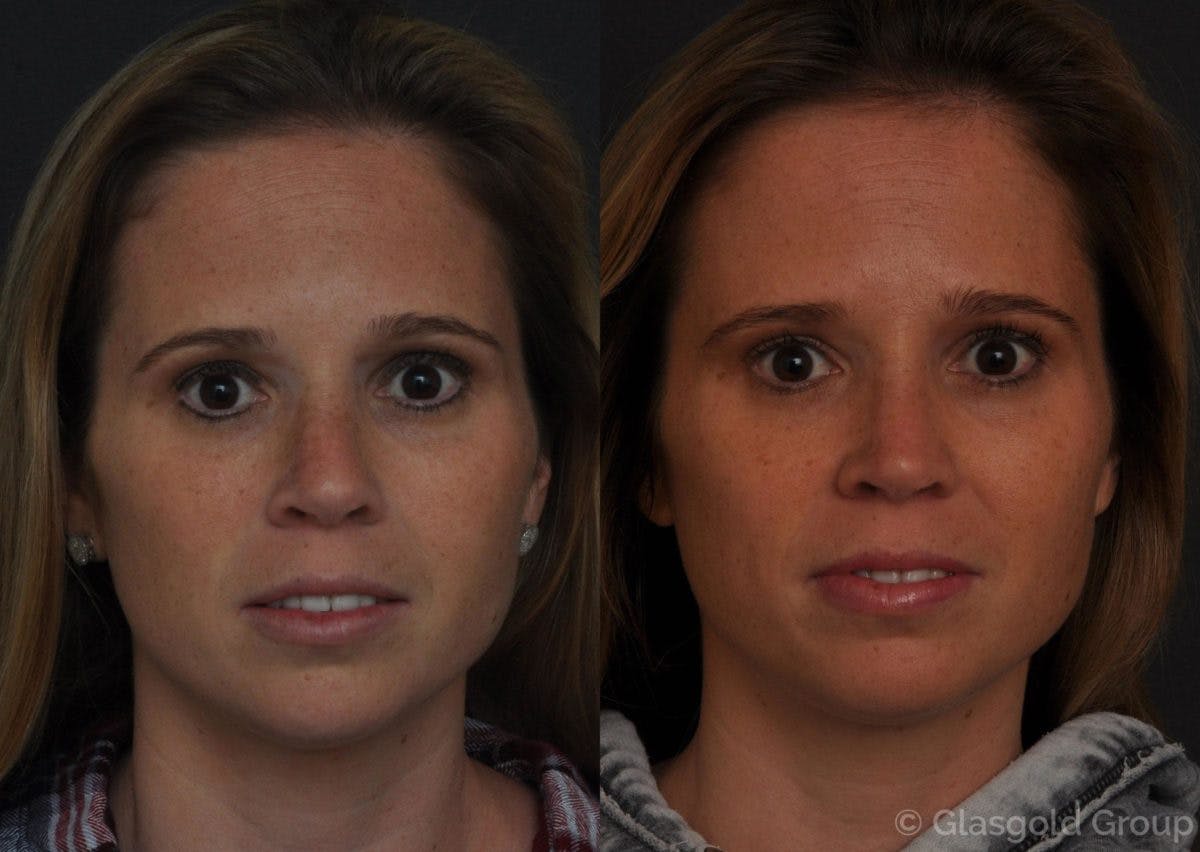 Revision Rhinoplasty Before & After Gallery - Patient 180117 - Image 2