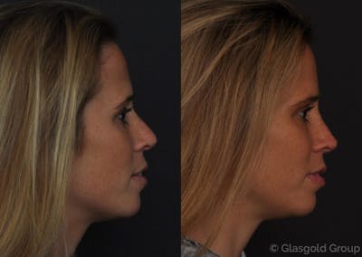 Revision Rhinoplasty Before & After Gallery - Patient 180117 - Image 1