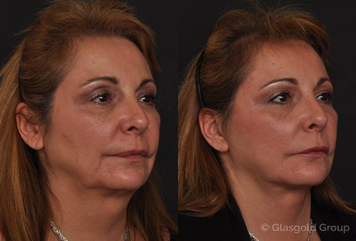 Facelift Before & After Gallery - Patient 210571 - Image 1