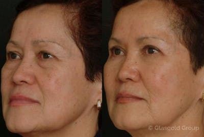 Upper Eyelid Before & After Gallery - Patient 186844 - Image 1