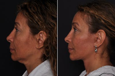 Facelift Before & After Gallery - Patient 168979 - Image 1