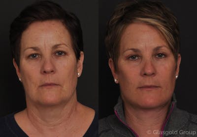Upper Eyelid Before & After Gallery - Patient 133232 - Image 1