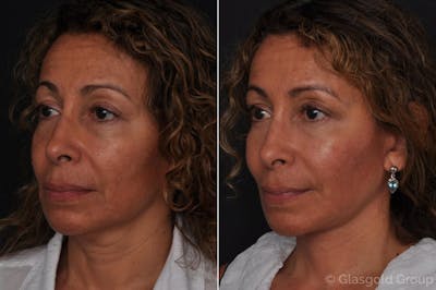 Facelift Before & After Gallery - Patient 168979 - Image 1