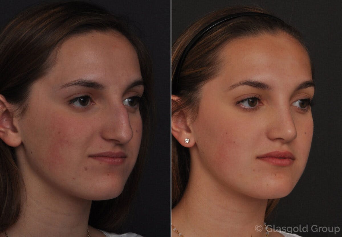 Rhinoplasty Before & After Gallery - Patient 225111 - Image 3