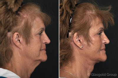 Facelift Before & After Gallery - Patient 220426 - Image 1