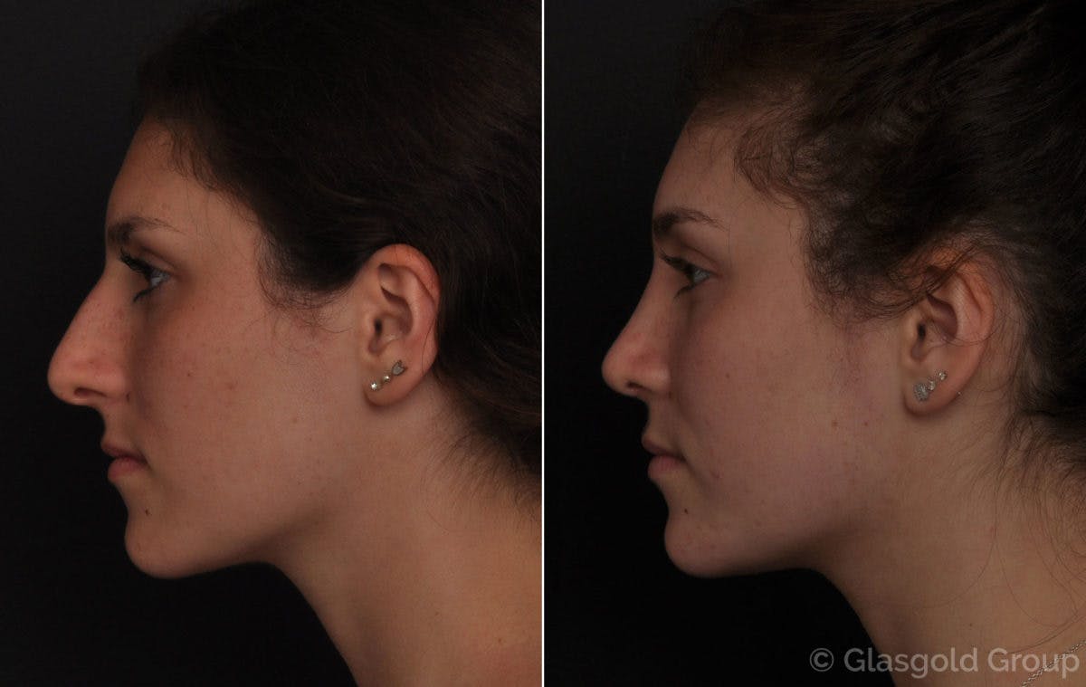 Rhinoplasty Before & After Gallery - Patient 285650 - Image 1