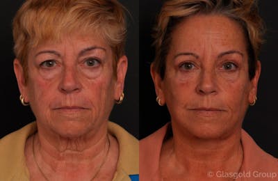 Upper Eyelid Before & After Gallery - Patient 119985 - Image 1