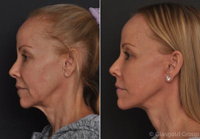 Facelift Before & After Gallery - Patient 177763 - Image 1