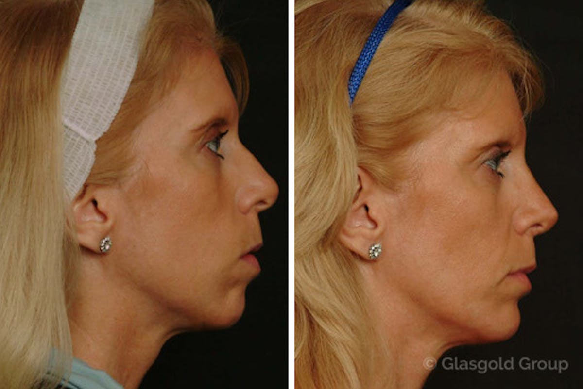 Chin Implants Before & After Gallery - Patient 344526 - Image 1