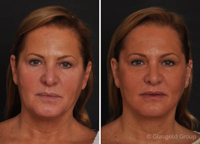 Upper Eyelid Before & After Gallery - Patient 410189 - Image 1