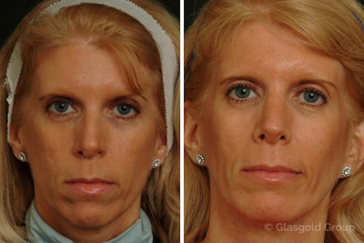 Chin Implants Before & After Gallery - Patient 344526 - Image 2