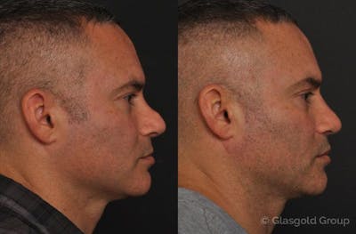 Revision Rhinoplasty Before & After Gallery - Patient 106385 - Image 1