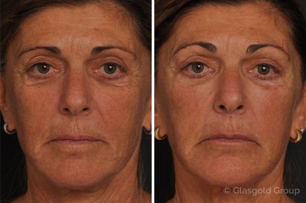 Fat Transfer Before & After Gallery - Patient 151237 - Image 2