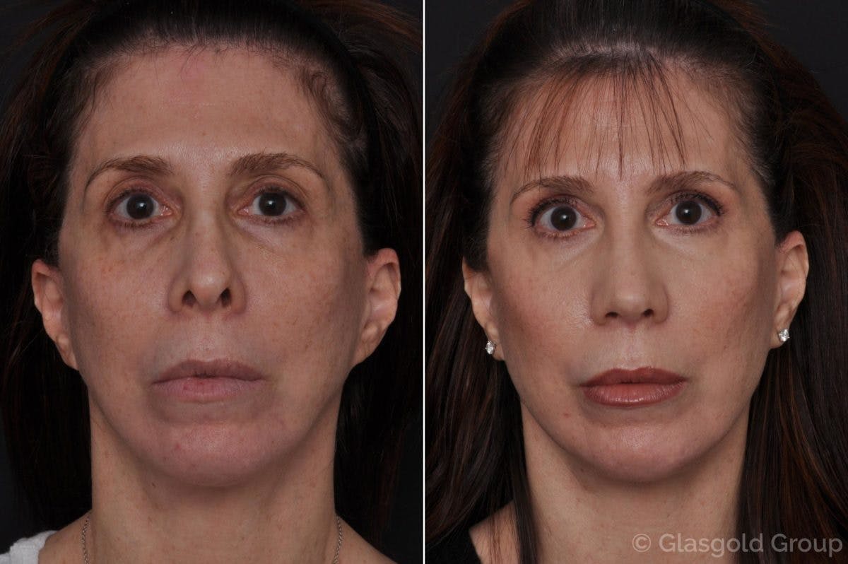 Upper Eyelid Before & After Gallery - Patient 266494 - Image 3