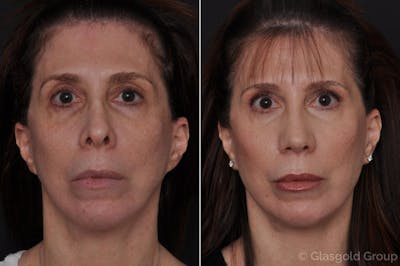 Upper Eyelid Before & After Gallery - Patient 266494 - Image 1