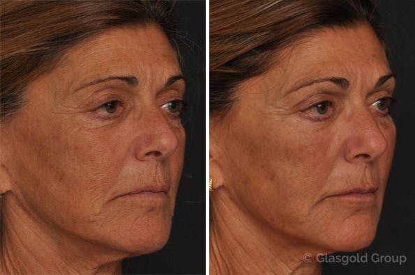 Fat Transfer Before & After Gallery - Patient 151237 - Image 1