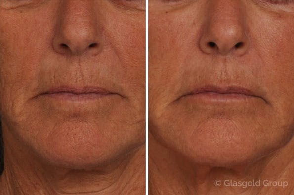 Fat Transfer Before & After Gallery - Patient 151237 - Image 3